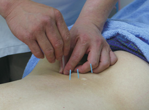 鍼（はり）治療
