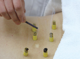 鍼（はり）治療